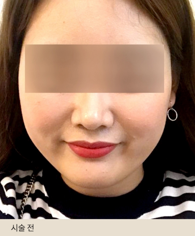 Titanium Cut Injection